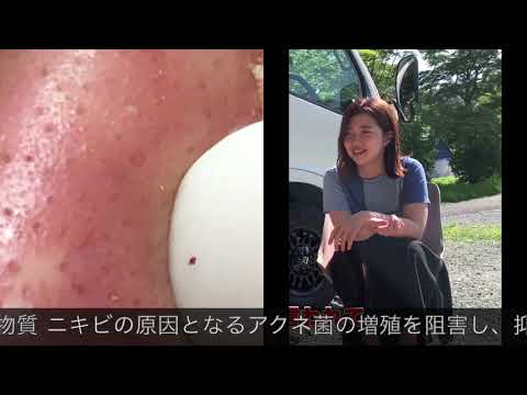 【ニキビ跡の治し方】福田麻貴、岡田将生と密会の秘密が【医師監修】