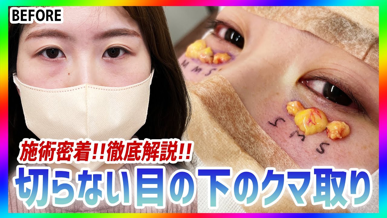 笑ったらプクッと出る目の下のクマをにゅるにゅると出して綺麗な目元に！【目の下のクマ取り/目の下のたるみ取り/目の下のふくらみ取り】