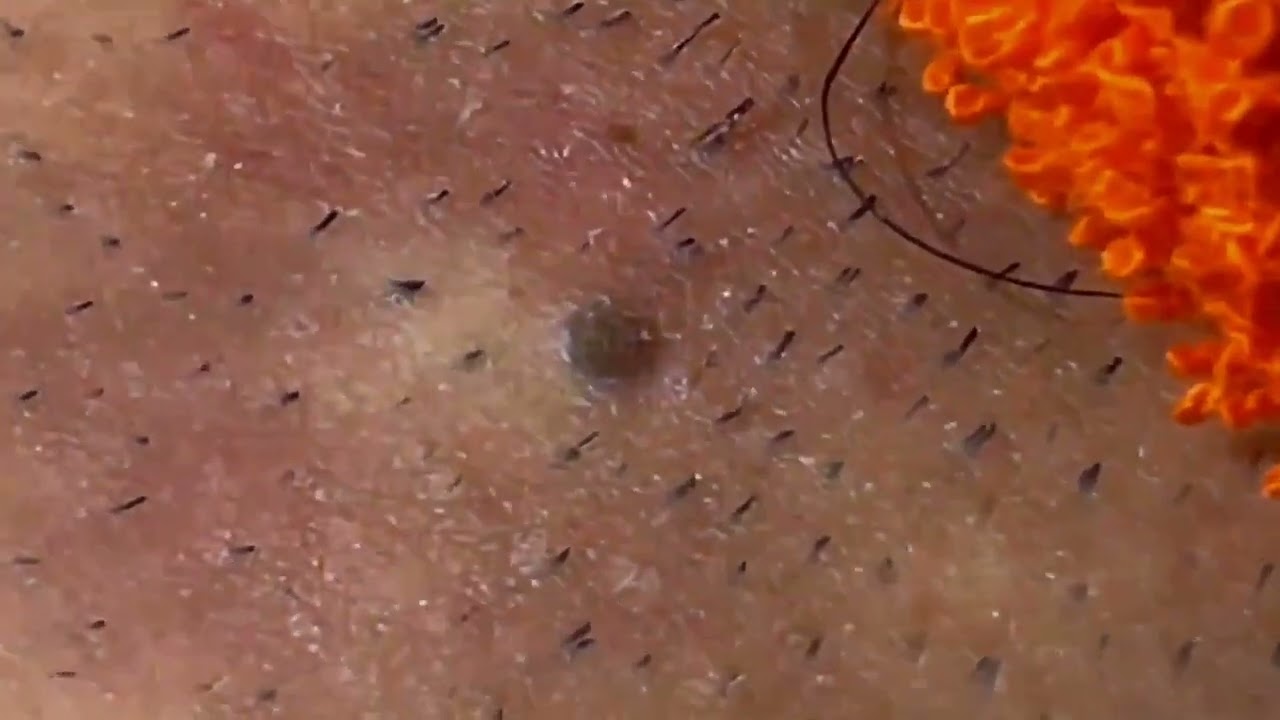 【角栓除去】超大量の”鼻の角栓”をにゅるにゅる圧出！【ブラックヘッド/ニキビ】／Blackhead Removal Show