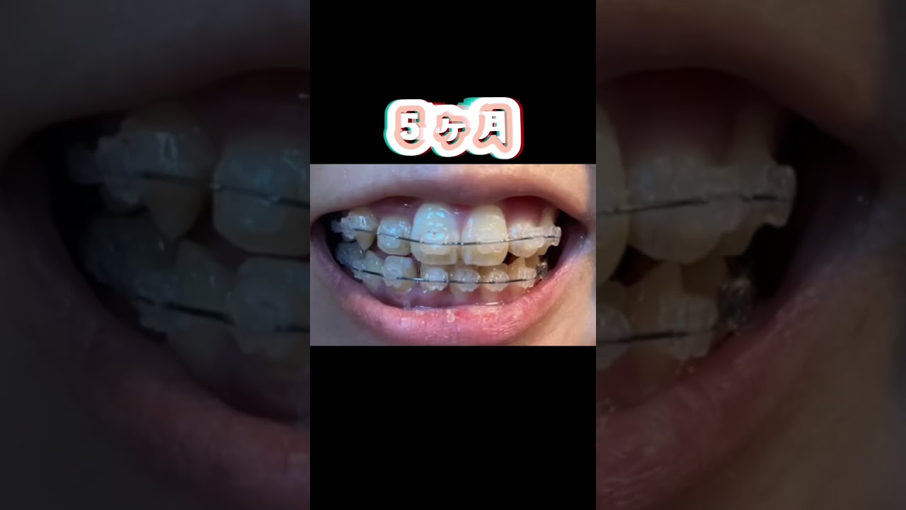【矯正１年変化】#shorts #歯列矯正 #ワイヤー矯正 #矯正