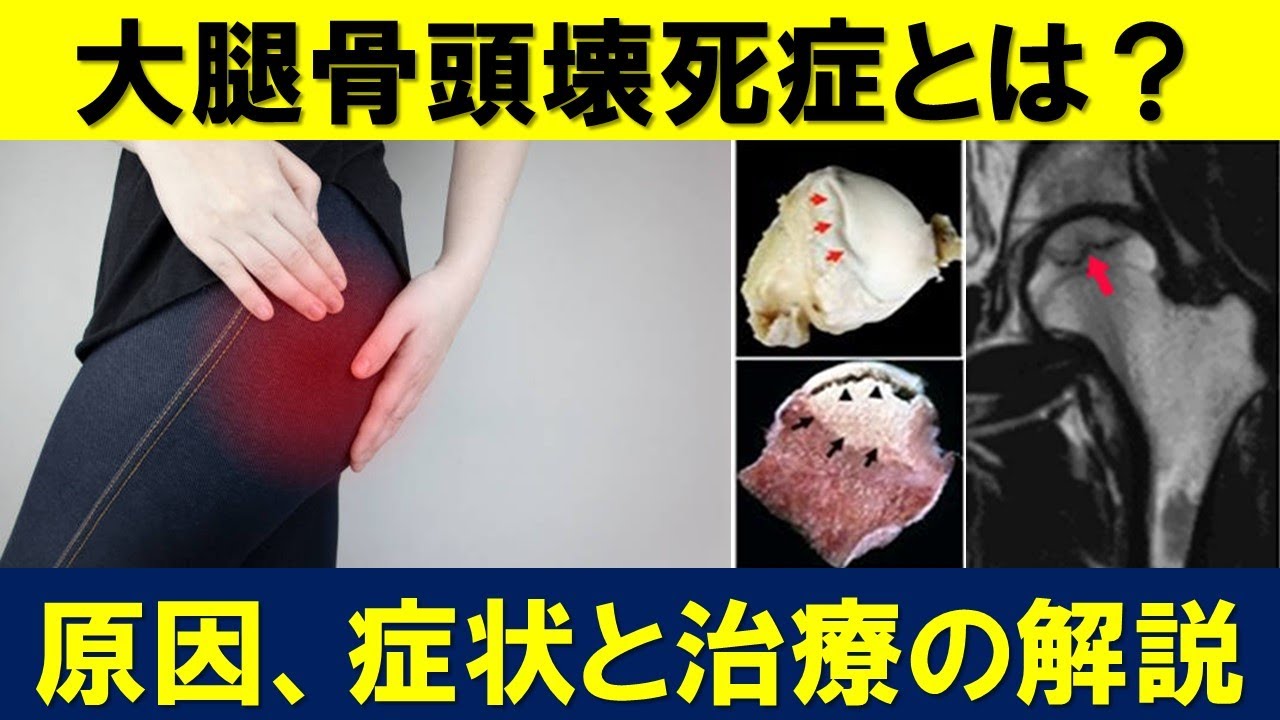 大腿骨頭壊死の原因と初期症状と治療について解説します！