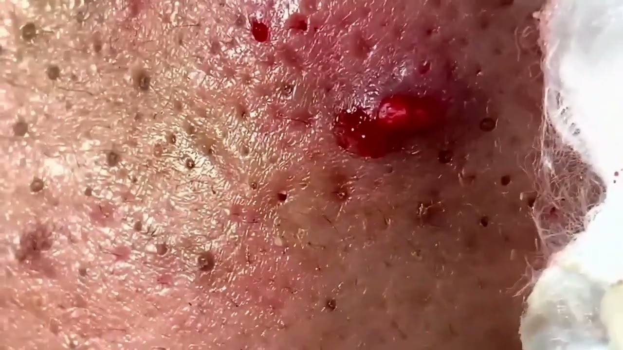 【角栓除去】超大量の”鼻の角栓”をにゅるにゅる圧出！【ブラックヘッド/ニキビ】／Blackhead Removal Show