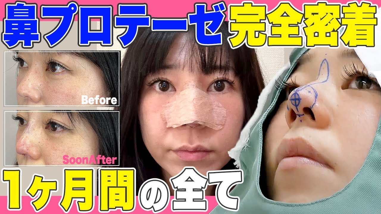 【プロテーゼ】鼻整形を完全密着！リアルダウンタイム1ヶ月間の全てをお見せます！【鼻尖形成で団子鼻も解消】鼻整形しょうぺい先生＠TCB