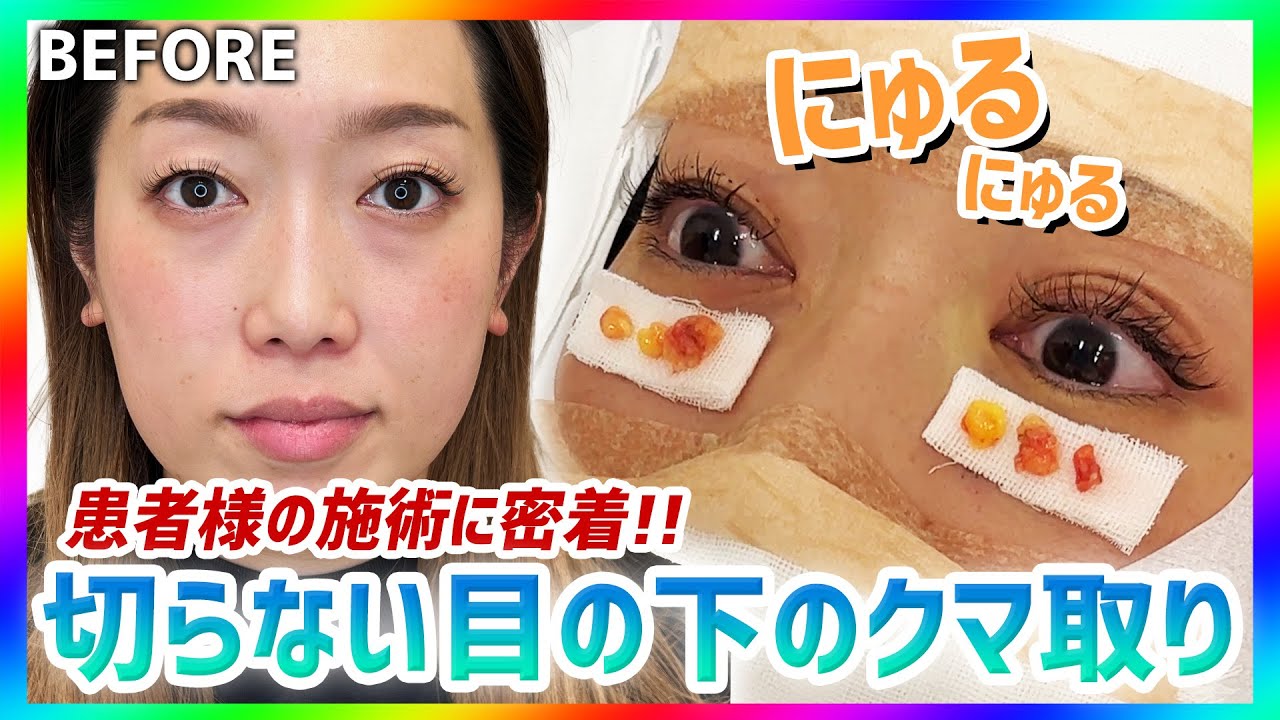 【クマ取り】目の下の脂肪をにゅるにゅる出して疲れ目を解消！実際の施術中の雰囲気も公開！【クマ取り整形/脂肪取り/目の下のふくらみ/目の下のクマ取り/目の下のたるみ取り】