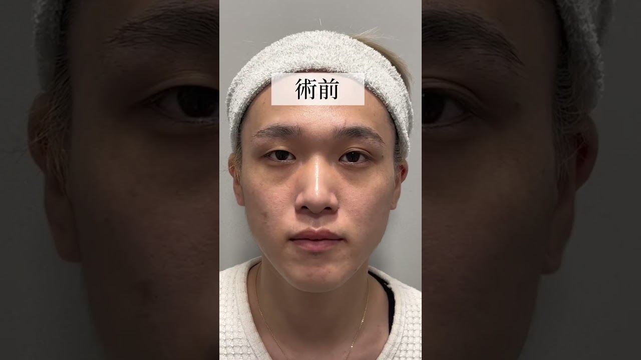 【全顔整形】ホストが全顔整形で衝撃の変化！#shorts