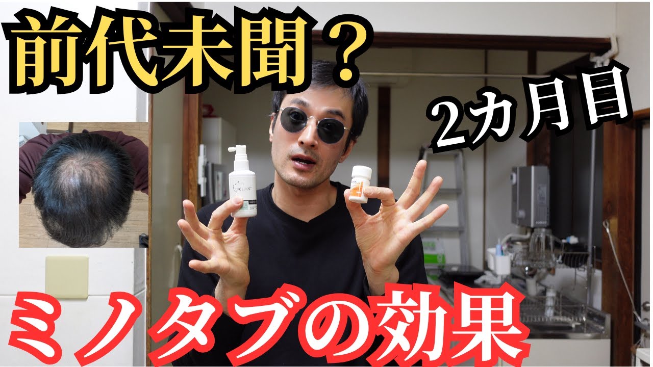 【医者もびっくり】フィナステリド・ザガーロ・デュタステリド・プロペシア無しで髪生えた【AGA治療・若ハゲ・M字ハゲ・薄毛・円形脱毛症】