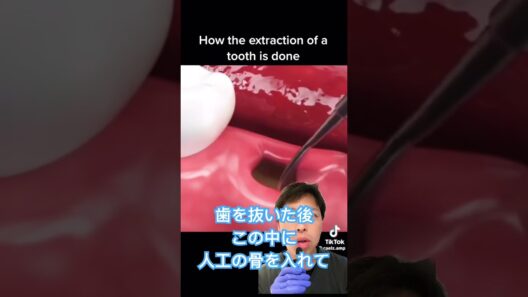 抜歯の後早く治す方法🦷#shorts #歯医者 #雑学 #歯科衛生士 #歯医者あるある #インプラント #抜歯 #骨造成