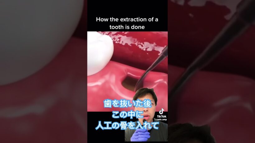 抜歯の後早く治す方法🦷#shorts #歯医者 #雑学 #歯科衛生士 #歯医者あるある #インプラント #抜歯 #骨造成