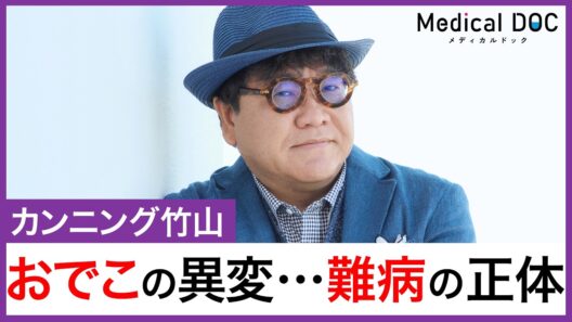 カンニング竹山、額の「強皮症」の実態が明らかに… “皮膚のへこみ”の正体とは
