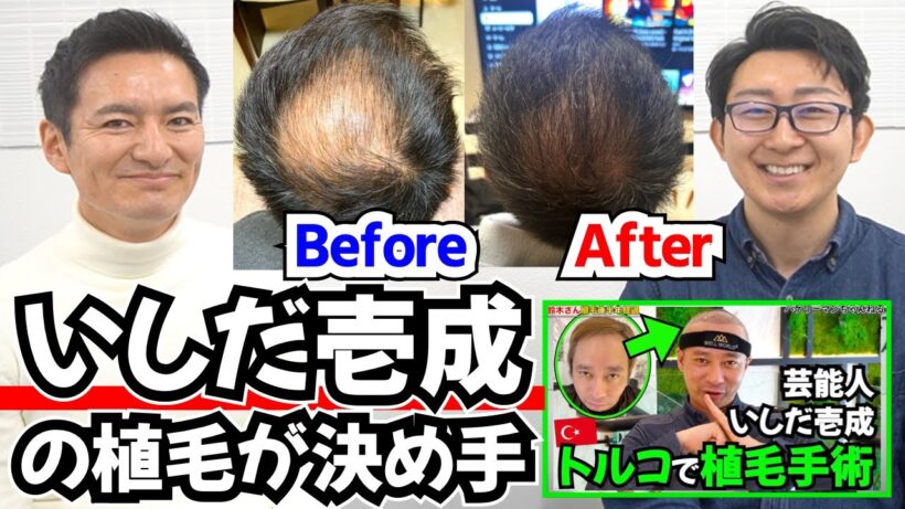 【テレビ】いしだ壱成のトルコ植毛を見て「植毛しよう！」と思った【自毛植毛｜鈴木さん】